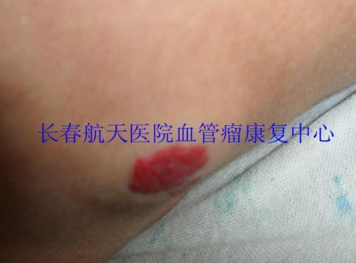 颈部血管瘤 颈部血管瘤