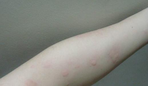 人疱疹病毒-6型感染 人疱疹病毒-6型感染