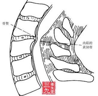 黄韧带骨化症 黄韧带骨化症