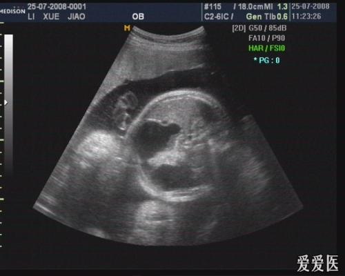 十二指肠先天性缺如、闭锁和狭窄 十二指肠先天性缺如、闭锁和狭窄