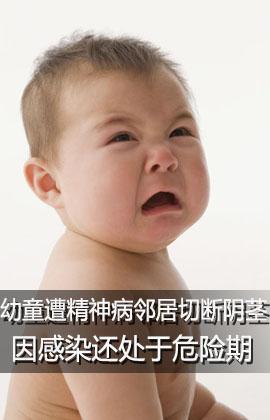 小儿假肥大型肌营养不良 小儿假肥大型肌营养不良