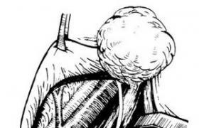 鳃裂囊肿和瘘管 鳃裂囊肿和瘘管