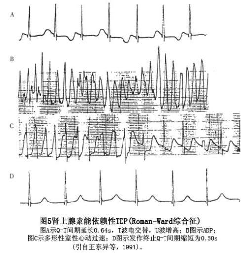 长Q-T间期综合征 长Q-T间期综合征