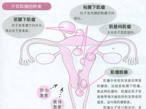 妊娠合并子宫肌瘤 妊娠合并子宫肌瘤