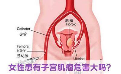 特殊型子宫肌瘤 特殊型子宫肌瘤