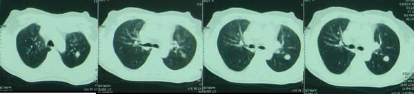 肺轉移瘤