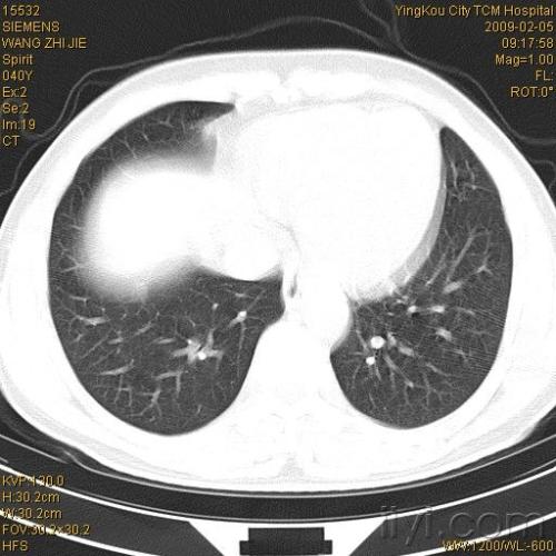 肺错构瘤
