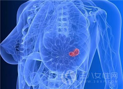 乳腺癌的早期症状有哪些.png