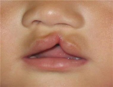 新生儿兔唇是怎么形成的 兔唇如何治疗会不会遗传