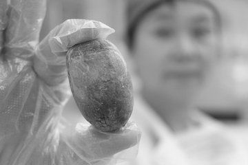 胆结石是什么原因引起的  胆结石对人体的危害有哪些