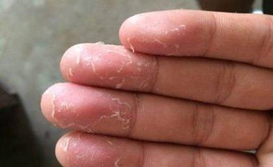 手部脱皮是什么原因引起的  手部脱皮的危害有哪些