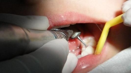 牙髓炎是什么引起的  牙髓炎有哪些症状