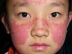 血管炎应该如何预防   血管炎是什么原因引起的