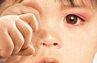 过敏性结膜炎应该如何预防  过敏性结膜炎是什么原因引起的