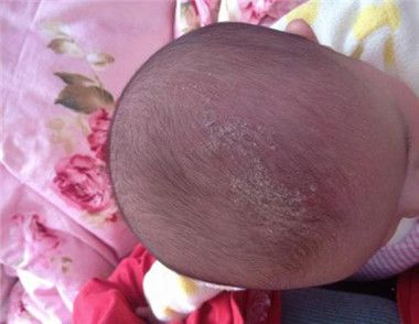 婴儿头垢是怎么形成的 如何为新生婴儿清洗头垢