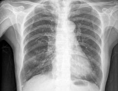 肺结核钙化是什么意思 肺结核钙化后还会复发吗