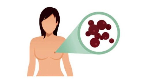 乳腺癌的发病原因有哪些···.jpg