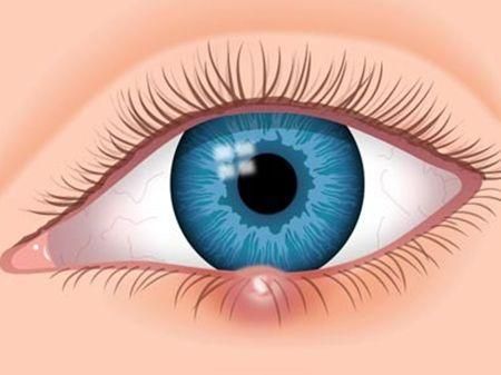 眼睛長針眼怎麼辦  眼睛長針眼的原因是什麼