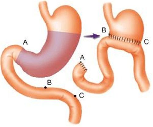 胃窦炎的发病原因有哪些·· 胃窦炎有哪些症状.jpg