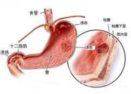 胃窦炎的发病原因有哪些 胃窦炎有哪些症状··.jpg
