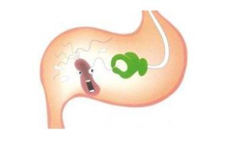 胃窦炎的发病原因有哪些 胃窦炎有哪些症状.jpg