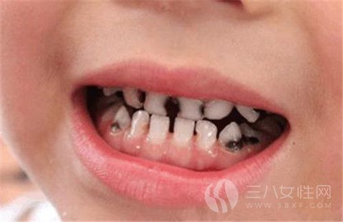 儿童龋齿的病因1.jpg