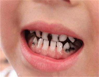 儿童龋齿的病因有哪些 儿童龋齿有什么危害