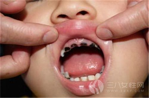 儿童龋齿的病因.jpg