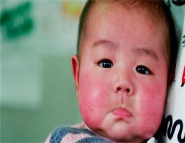 婴儿得了奶癣怎么办 为什么会得奶癣