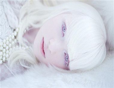 白化病是什么 白化病如何进行治疗