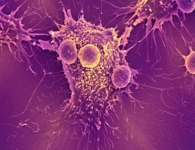 癌症复发办告别宴是什么情况 复发率最高的癌症是什么