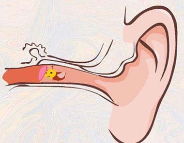 虫子入耳怎么办 如何防止异物入耳