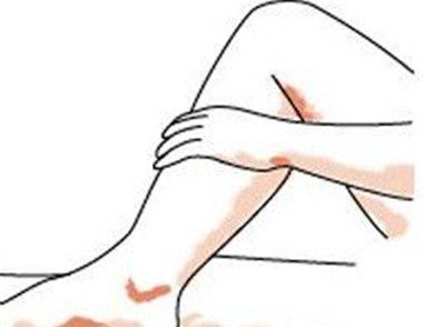 造成女性小腿水肿的原因有哪些 怎样按摩可以消除小腿水肿