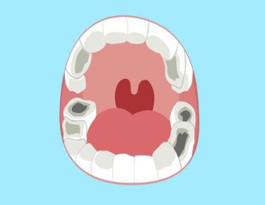 引起蛀牙的原因有哪些 蛀牙的症状是什么
