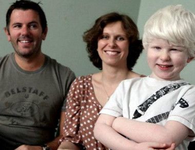 白化病为什么怕光 怎样预防白化病