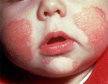 什么是湿疹 为什么春季人们会得湿疹