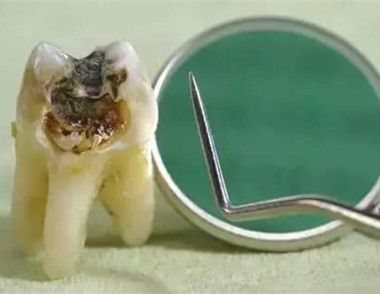 成人龋齿有哪些治疗方法 导致成人龋齿的原因有哪些