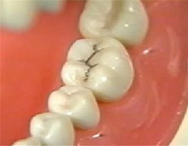牙齿上长了黑斑是什么原因 怎么去掉牙齿上的黑斑