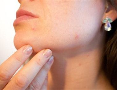 吃火龙果过敏会有什么症状 吃火龙果过敏了怎么办