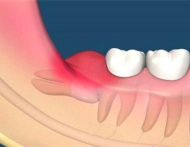牙齦腫痛可能是什麼原因引起的 牙齦腫痛怎麼辦