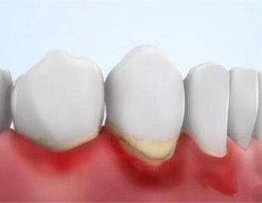 牙周炎有哪些症狀表現 牙周炎要怎麼治療