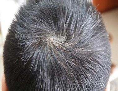 什么是少年白 少年白是什么原因