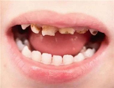儿童龋齿挂什么科 儿童龋齿怎么护理