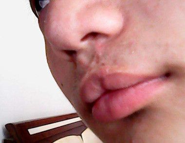 兔唇是怎样形成的 兔唇儿童怎样喂养