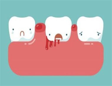 牙龈出血的原因有哪些 如何预防牙龈出血