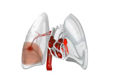 肺栓塞是怎样引起的