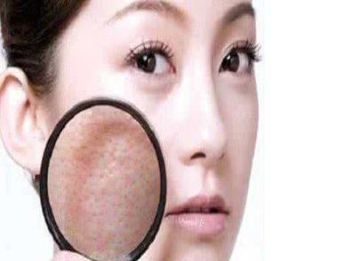 毛孔粗大是什么原因 毛孔粗大怎么改善