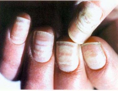 什麼是灰指甲 灰指甲的原因是什麼