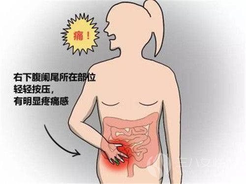 急性阑尾炎有什么症状表现