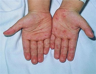 手足口病發燒怎麼辦 手足口病發燒幾天能退